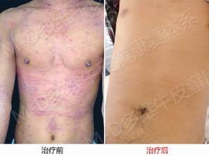 郑州牛皮癣医院治疗牛皮癣