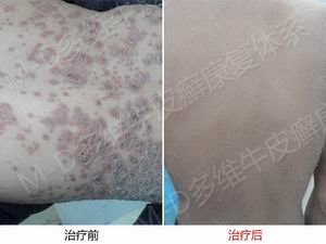 郑州牛皮癣专科治疗医院