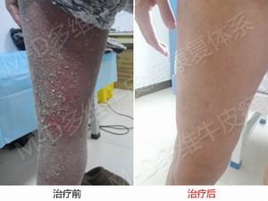 郑州牛皮癣医院