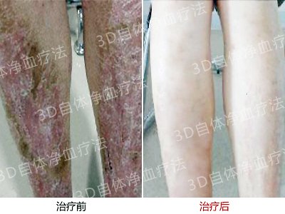 患者身上出现脓包怎么办