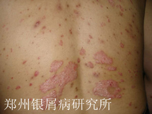 牛皮癣潜伏期有哪些症状表现