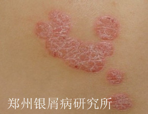牛皮癣发病原因