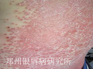 如何预防牛皮癣发作