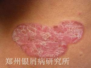 生活中银屑病病因有哪些