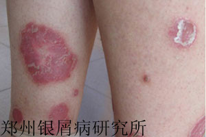 牛皮癣预防