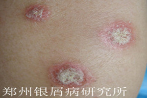 牛皮癣饮食