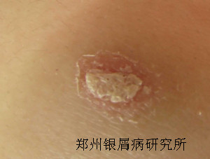 牛皮癣饮食