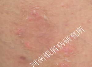 牛皮癣治疗