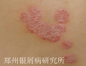 牛皮癣治疗